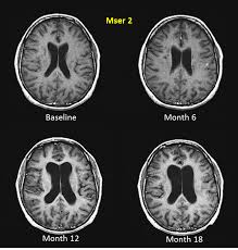 In scleroza multipla, sistemul imunitar ataca mielina, substanta care intra in alcatuirea nervilor cerebrospinali si provoaca probleme de comunicare intre creier si restul corpului. Scleroza Multipla