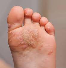 Some warts can be prevented, others cannot be prevented. Warts And All What You Need To Know About Warts Ctd