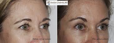 Apr 15, 2019 · articles by melissa giordano. Nonsurgical Brow Lift With Botox Or Dysport