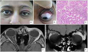 Image result for Dacryoadenitis