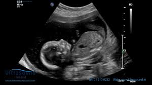 Is xx gender in my ultrasound means girl? 18 Week Ultrasound Images And What To Expect