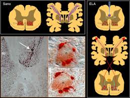 La esclerosis lateral amiotrófica (ela) es la más frecuente del grupo de las enfermedades motoneuronales, aunque inicialmente se había esclerosis lateral amiotrofica clínicamente definida, clásica, segmento inicial cervical mayo/11. Neuroimagen Y Ensayos Clinicos Con Celulas Madre En La Esclerosis Lateral Amiotrofica Perspectivas De Presente Y Futuro Sciencedirect