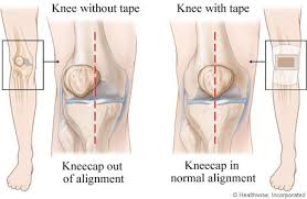 Image result for Patella Tracking Assessment