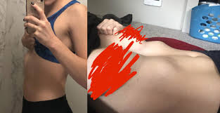 Pectus excavatum, also known as funnel chest or trichterbrust 13, is a congenital chest wall deformity characterized by concave depression of the sternum, resulting in cosmetic and radiographic alterations. Women With Pectus Excavatum Life With Pectus
