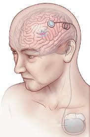Neural network dynamics in Parkinson's disease