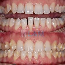 Dental clinic pojednostavljuje pacijentima rezervaciju termina te ubrzava i olakšava stomatolozima naručivanje pacijenata. L M Dental Clinic Pj Braces On Twitter Present Of Spaces Between Teeth Are One Of The Reason Patient Go For Braces Treatment In Petaling Jaya Https T Co Fypz4h3q4e Https T Co 272bnvqbeg