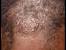 Dry Flaky Scalp African American Hair