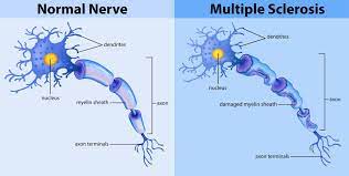 We did not find results for: Multiple Sclerosis Important Things You Need To Know