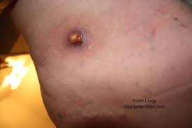 The venom of brown recluse spiders causes necrosis (damage and breakdown) of skin and tissue. Brown Recluse Spider Bite Badspiderbites Com
