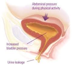 Pelvic Floor Repair Incontinence Bladder Urinary Incontinence