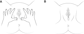 Image result for Labial Fusion