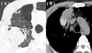 Aspergillosis (aspergillus infection) is a fungal infection. Epos
