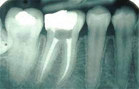 Root Canal What To Expect During A Root Canal Root Canal Root Canal Treatment Restorative Dentistry