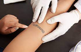 In general, the cost is calculated at $35 per square inch, per treatment; Does Laser Tattoo Removal Hurt Other Faqs