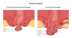 Image result for Rectal prolapse