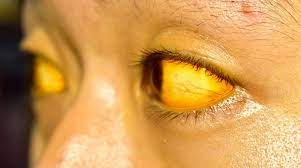 We did not find results for: Penyakit Kuning Jaundice Gejala Penyebab Pengobatan Dll