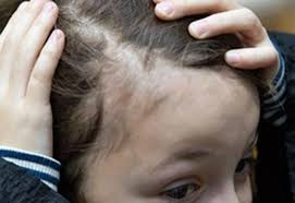 Their skin may turn red, scaly, and bumpy. Hair Growth In Children For Android Apk Download