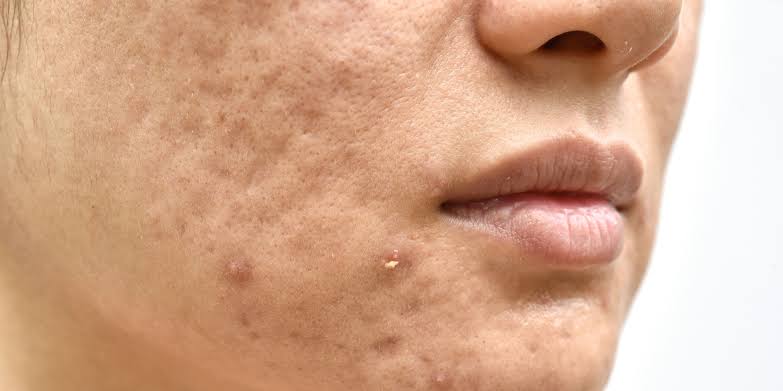 Everything You Need To Know About Acne Scarring - Dr Nerina Wilkinson +  Associates