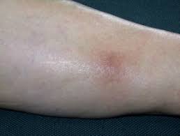 It won't clear up with stretching or walking it off like an ordinary charley horse. Superficial Thrombophlebitis Dermnet Nz