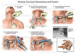 Anterior Cervical Discectomy And Fusion My Husband Was Told He Absolutely Needed This Done Over 20 Years Ago Cervical Neck Surgery Degenerative Disc Disease