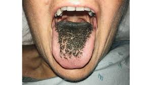 Image result for black hairy tongue symptoms