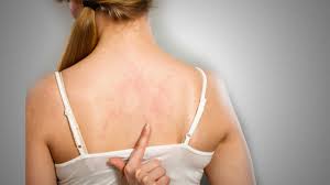 Egzama Neden Olur Ve Nasil Gecer Egzamaya Ne Iyi Gelir Evde Bitkisel Cozumler Ve Dogal Yontemler Saglik Haberleri