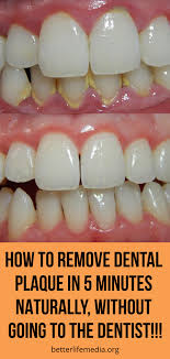 Garlic is a natural bacteria killer. How To Remove A Tooth Without A Dentist Arxiusarquitectura