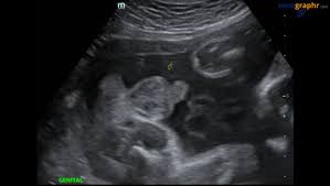 Growth Scan Atau Scan Biasa Ultrasound Scan Bangi Putrajaya Kajang