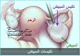 علاج تكيسات المبايض بالحجامة يعرف تكي س المبايض بأنه من الأمراض النسائية الشائعة وهو مرض يصيب المبايض فيحدث اضطراب لعملية الإباضة الطبيعي ة بسبب خلل هرموني في الجسم ويقترن في الأغلب مع عد ة مظاهر