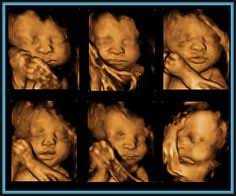 13 3d Ultrasound Ideas 3d Ultrasound 4d Ultrasound Ultrasound