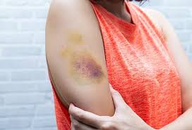 Dvt or deep vein thrombosis is a blood clot in the leg. Bruise Treatment Home Remedies