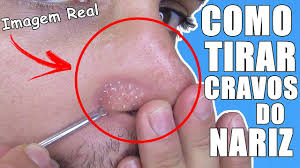 Todo mundo tem cravinhos no nariz mesmo? Como Tirar Cravos E Espinhas Em Casa Muito Facil Divos Ensinam Youtube