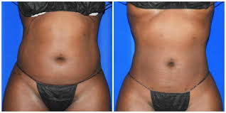 Other factors that can affect the cost of liposuction surgery: Can You Get A Flat Stomach With Liposuction Houston Lipo Center