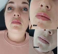 0.5 ML LIP FILLER 💋 , ..., .., ., #lipfiller #lipaugmentation  #lipfillersuk #cosmeticinjectables #injections #injectables  #aestheticspractitioner