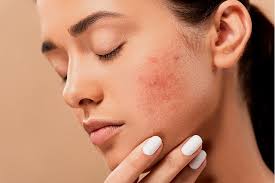 Berikut cara yang tepat untuk merawatnya. Segera Berhenti Ini Tanda Tanda Skincare Tak Cocok Dan Merusak Kulit