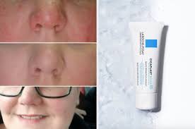 Another possible cause, especially i. Beauty Products For People With Rosacea