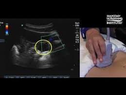 This is only done if you cannot have surgery because of advanced cancer or some other serious medical condition, because. Hot Tips Locating The Ovaries On Transabdominal Ultrasound Youtube
