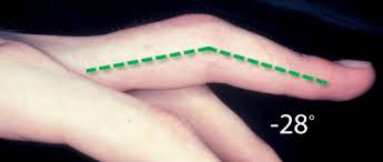 Image result for Lateral PIP Dislocation