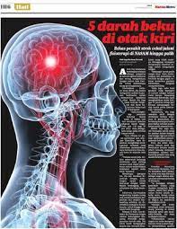 Penyanyi kelahiran setiu, terengganu itu akui terkejut apabila dimaklumkan oleh doktor mengenai keadaannya. 5 Darah Beku Di Otak Kiri Klik