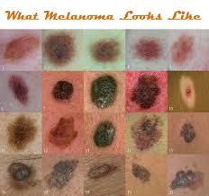 Pin On Melanoma