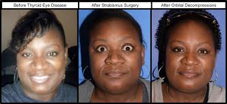 Thank you to the Thyroid Eye Clinic for straightening my eyes and making me  look like myself again!"