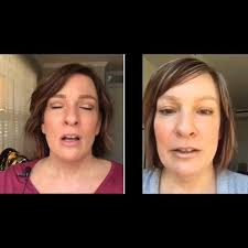 After 8 fibroblast treatments...