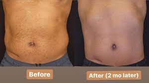 Check spelling or type a new query. Coolsculpting Reviews Before And After Coolsculpting
