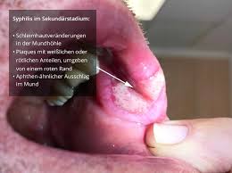 Hier sind nur wenige und sehr flache schleimhautdefekte im mund oder genitalbereich zu finden, die nach kurzer. Wie Aussert Sich Eine Syphilis Im Mund
