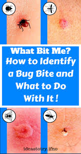 How To Identify A Bug Bite And What To Do With It Invitations Health Have Fun