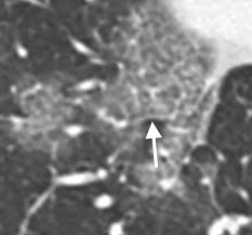 CT Imaging Features of 2019 Novel Coronavirus (2019-nCoV)Radiology