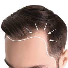 Ärzte für haartransplantation in stuttgart und umgebung (311 treffer). Ko Hair Haartransplantation In Deutschland Ko Hair