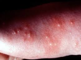 Image result for Papular urticaria