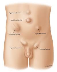 Efficacy comparison of the laparoscopic total extraperitoneal prosthetic and the lichtenstein herniorrhaphy for inguinal hernia. Hernia What Are The Causes Hernia Surgery Dubai