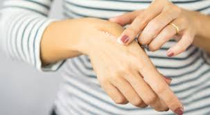 مراحل شفاء الحروق ونصائح لشفاء سريع ويب طب